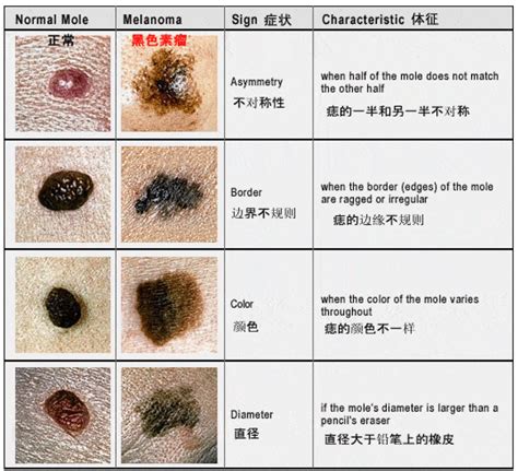 胸部有黑痣|痣也可能会癌变！长在 3 个地方要注意